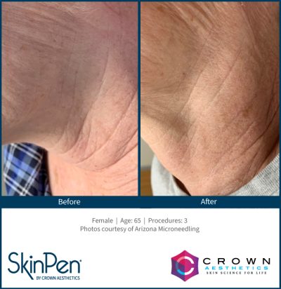 BA-SkinPen-FLAW-KH-Neck-ArizonaMicroneedling-3treatments-65YO_ppi_300_quality_100_embedMetadata_true_contentETag_2_embedColorProfile_true